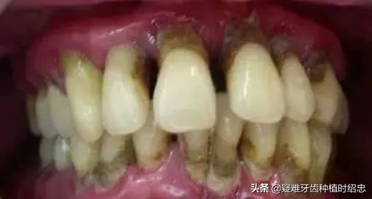 牙缝大是福是祸,牙缝宽什么命运