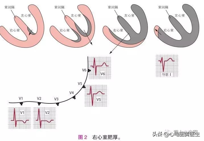 右心室肥厚心电图表现,右心室肥厚图