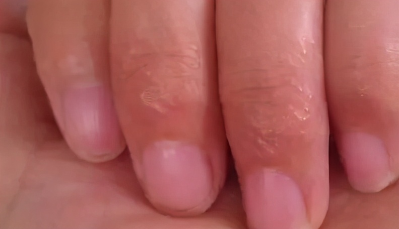 手脱皮是因为缺维生素吗,手脱皮主要是怎么造成的