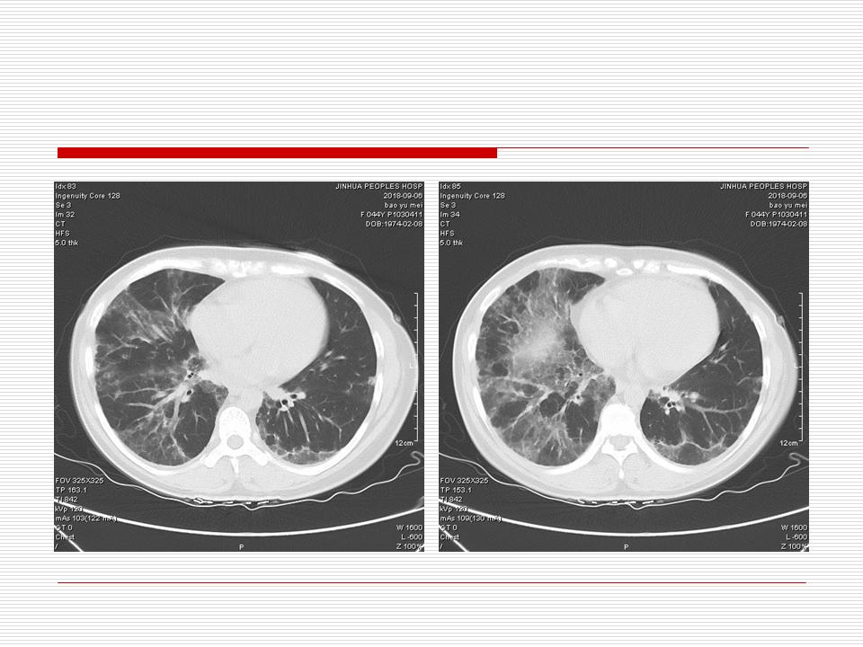 像炎症的肺癌能治好吗,医生说可能是肺癌也可能是炎症