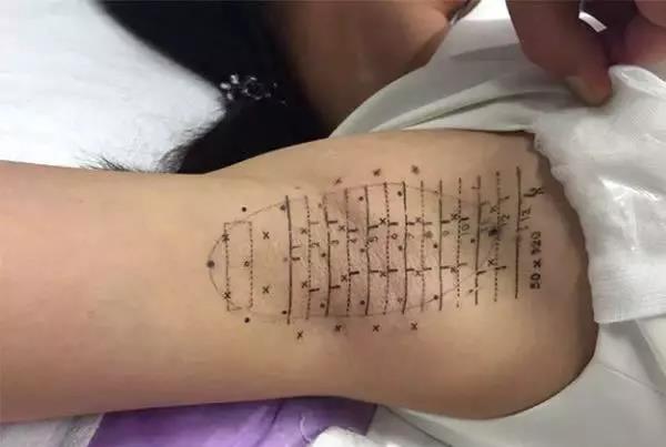 清新微波治疗腋臭一次的价格,清新微波治狐臭