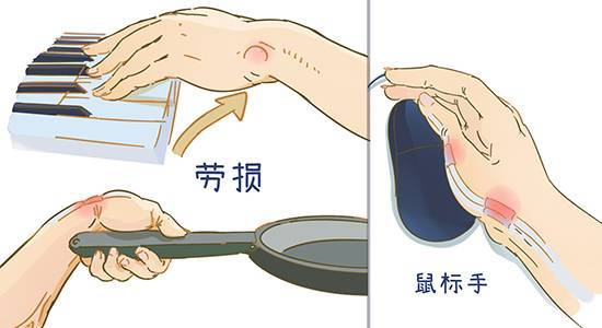 扳机指如何治疗,扳机指要怎么治疗