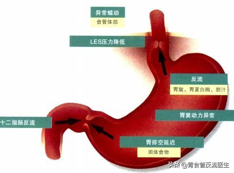 呕吐后食道有异物感吞咽疼痛,偶尔有呕吐感是什么原因