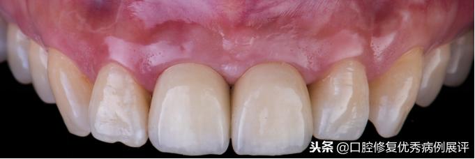 展评优秀病例赏析|Asc全瓷角度基台一体冠进行种植前牙美学修复
