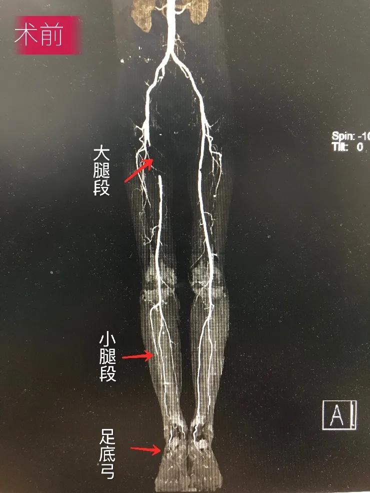 福州有下肢动脉硬化闭塞中医,辽宁中医治疗下肢动脉硬化闭塞