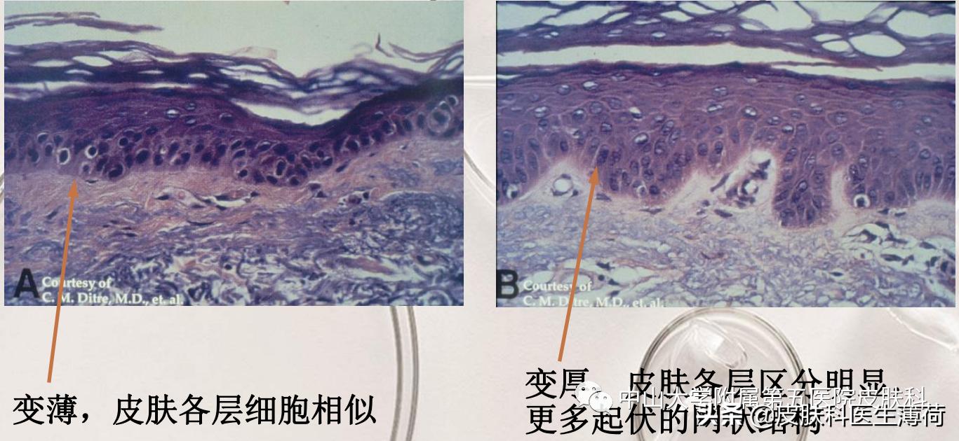 刷酸用果酸还是水杨酸,医生不会告诉你祛脚气的秘密
