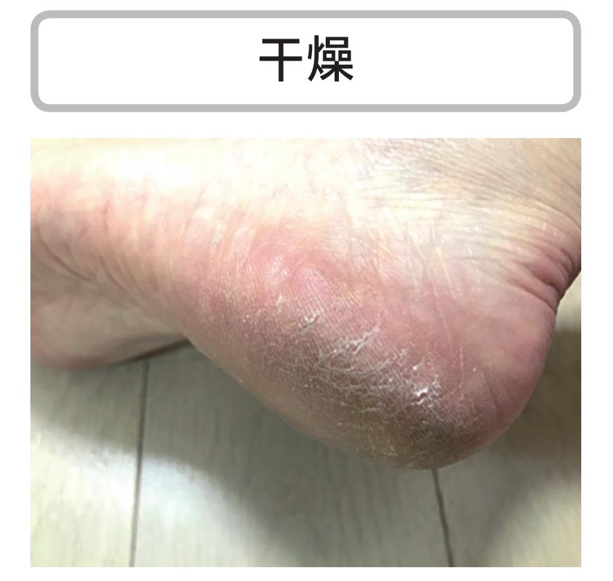 硬邦邦的老茧，会痛的鸡眼，日本皮肤科专家教你矫正足部恶习