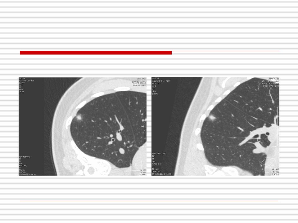 像炎症的肺癌能治好吗,医生说可能是肺癌也可能是炎症