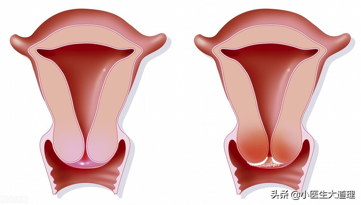 子宫颈浸润癌的主要症状,子宫颈炎症