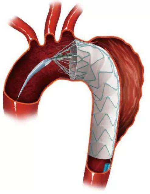 主动脉夹层为什么会这么凶险,异常凶险的心脏病主动脉夹层