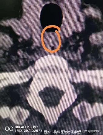 骨鲠,消化内镜可以做什么治疗