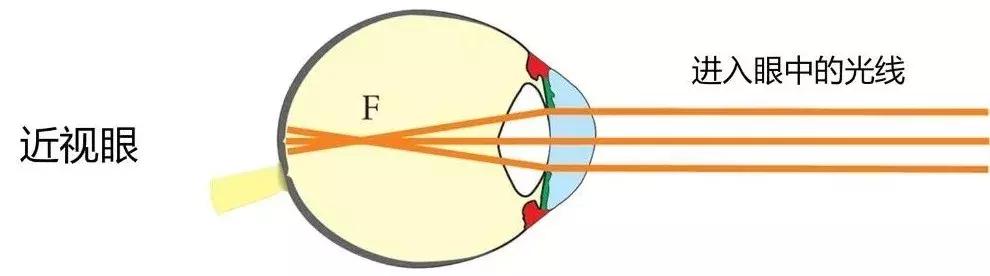 为什么说近视不是看电视造成的,为什么说近视治不好