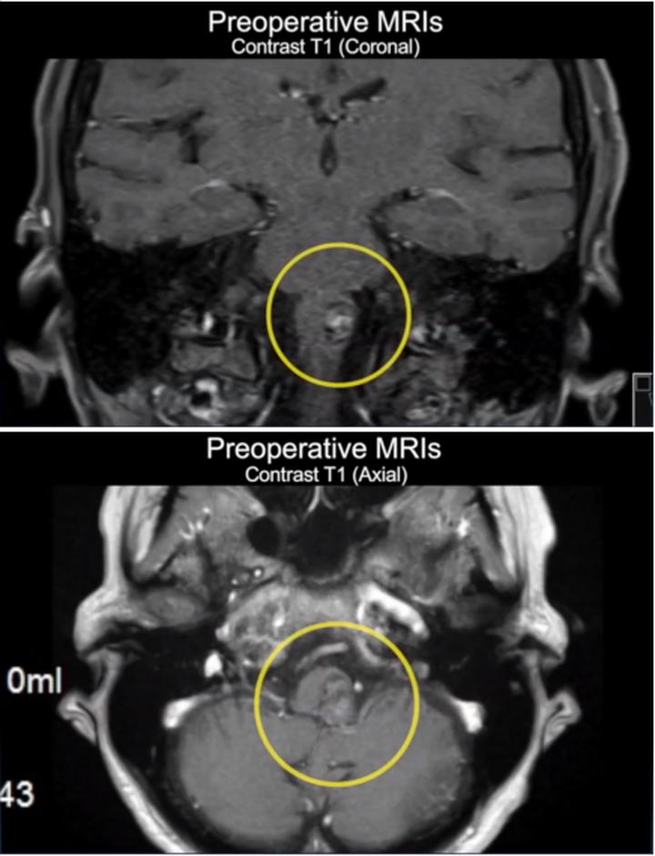 脑干海绵状血管瘤开颅手术,脑干做手术的示意图