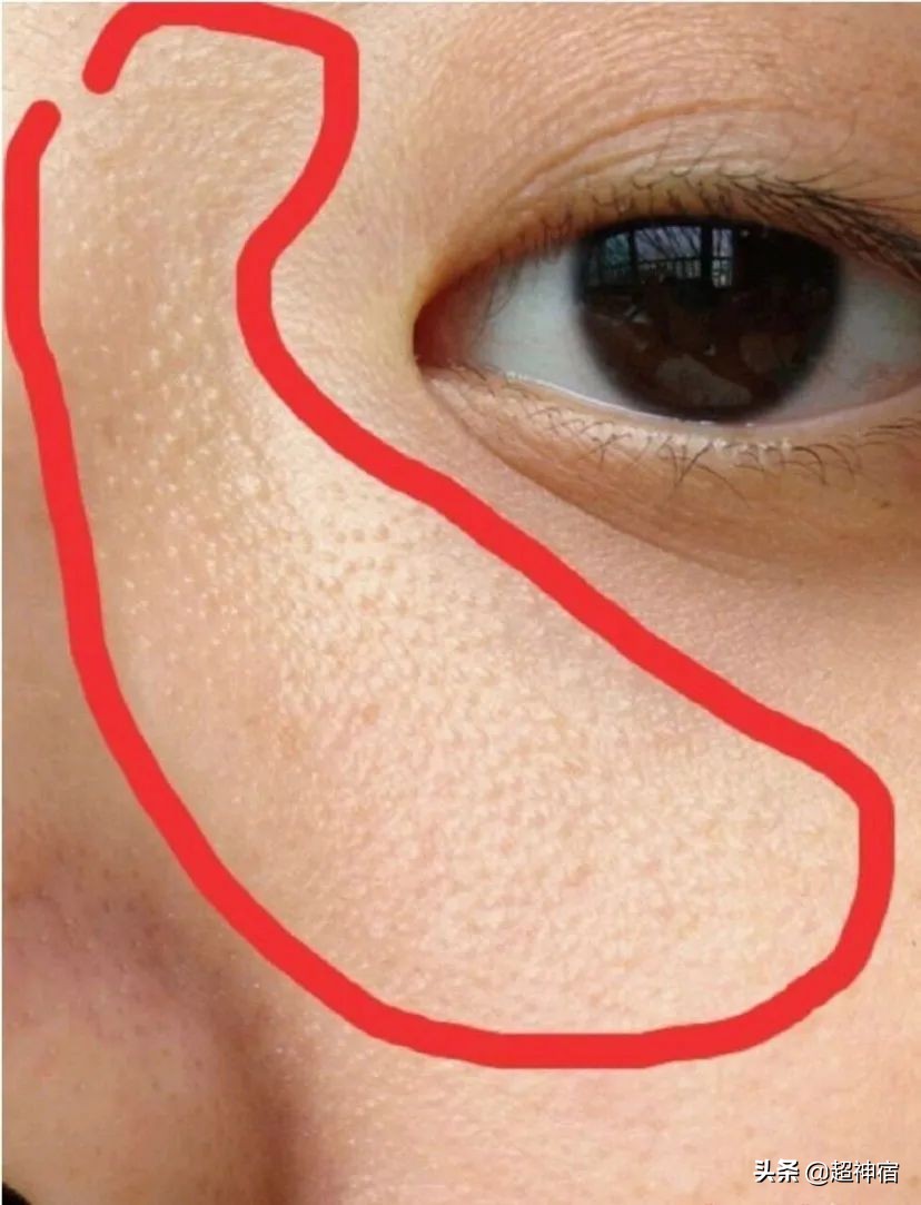 教你5个根治闭口粉刺方法,闭口痘痘彻底根治