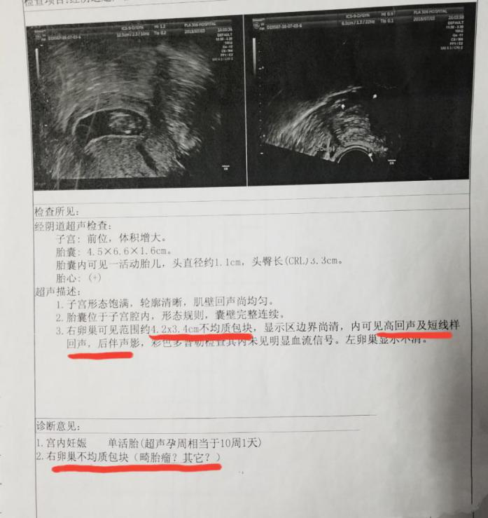 孕晚期突发腹痛:当心卵巢肿瘤扭转