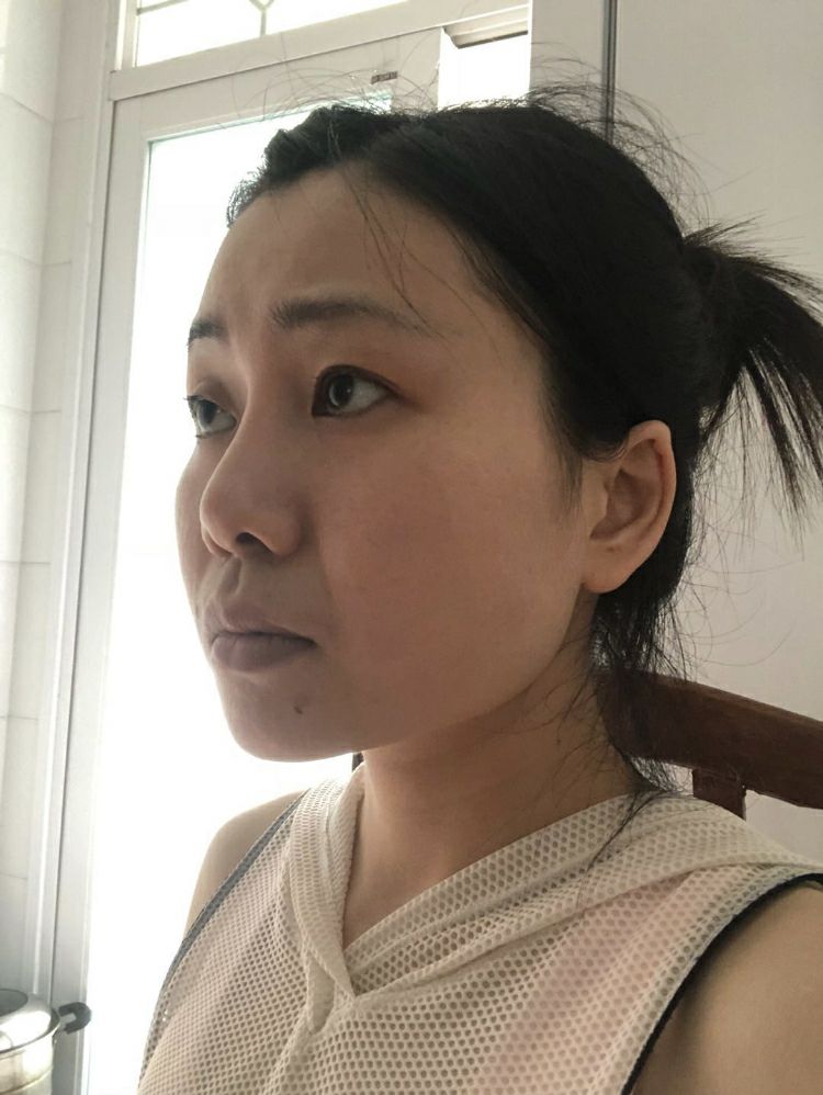 大小眼+歪鼻改善！精致感立显，仿若换头！