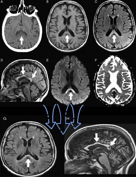 胼胝体有什么症状,胼胝体形态较小可以治疗吗