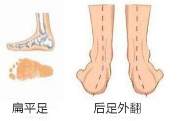 产后脚后跟疼的原因在这里,两个方法帮你改善