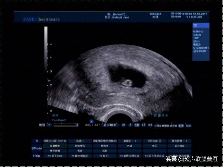 3毫米卵黄囊未见胎芽正常么,40多天的卵黄囊