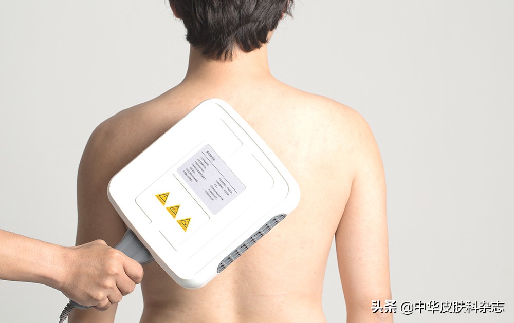 成都白癜风uvb光疗费用,nb-uvb治疗费用