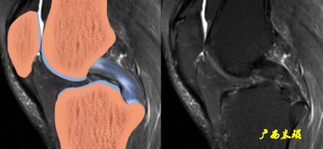 交叉韧带损伤的mr表现,后交叉韧带损伤的诊断实验