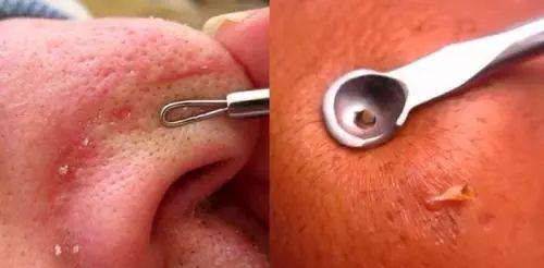 挤黑头和吸黑头哪个对毛孔损伤大,改掉挤黑头的习惯黑头会有改善吗