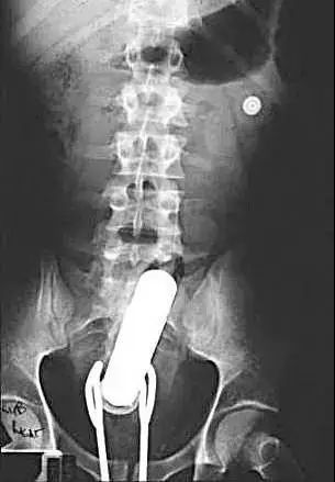 异物进入直肠?先别嫌丢人,赶紧去看医生吧