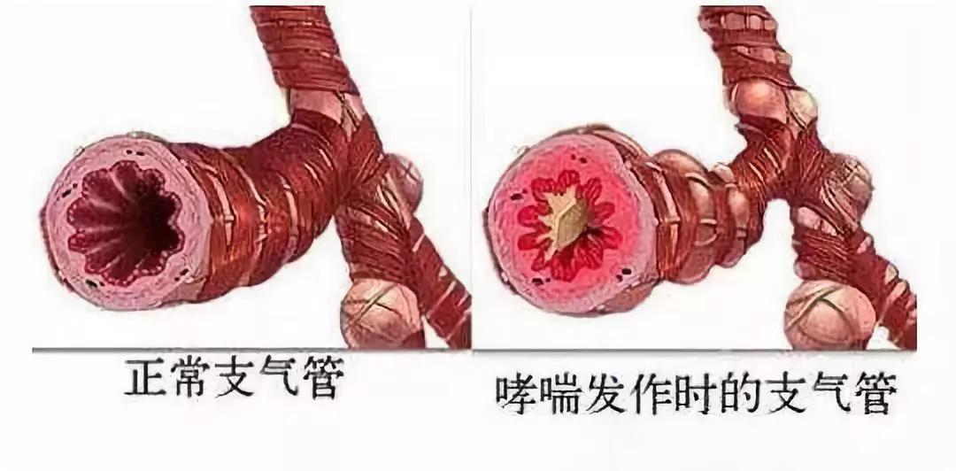 紧急情况起不来怎么办,咳嗽喘不上气紧急处理