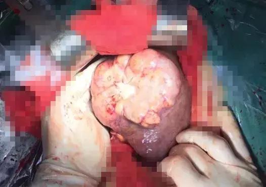 湖南株洲公交车司机突然发病,肝癌破裂大出血抢救无效死亡