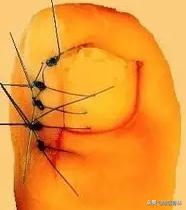 脚趾甲没扎到肉但是很痛怎么回事,脚指甲扎穿肉