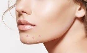 下巴反复长痘痘的原因和解决方法,下巴老是长痘痘怎么调理身体啊