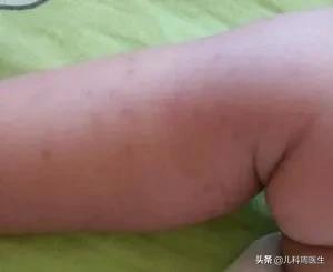 出生第二天宝宝皮下有出血点,40多天的新生儿皮下出血怎么办