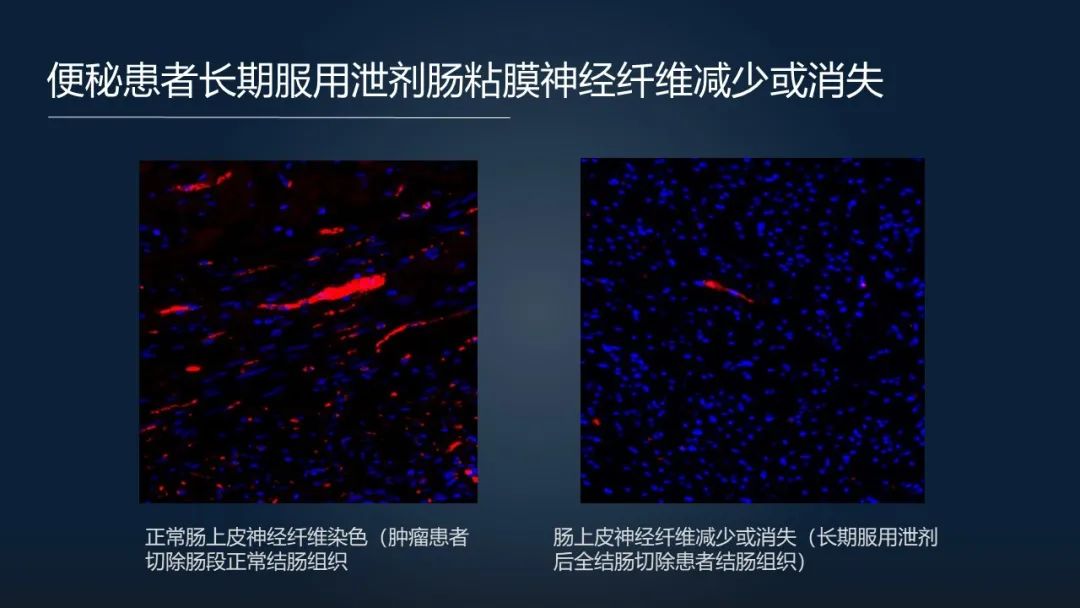 一招调理肠道改善便秘,肠道水疗治便秘有效吗