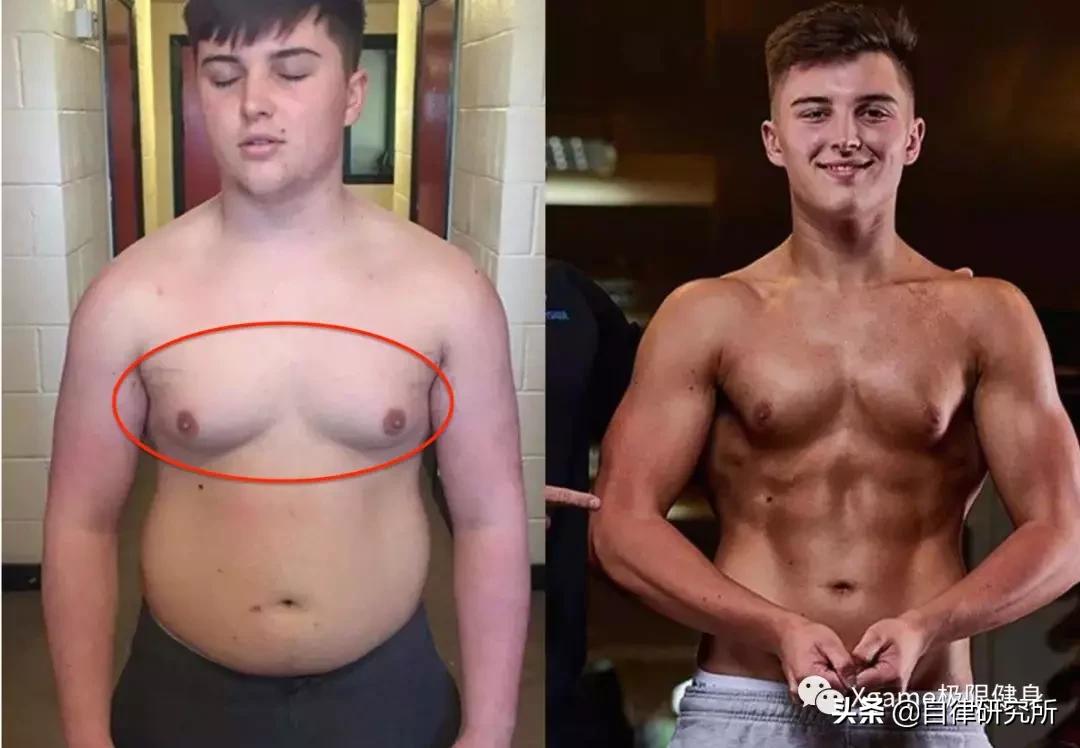 男性雌化胸的最佳治疗方法,男士雌化胸怎么改善