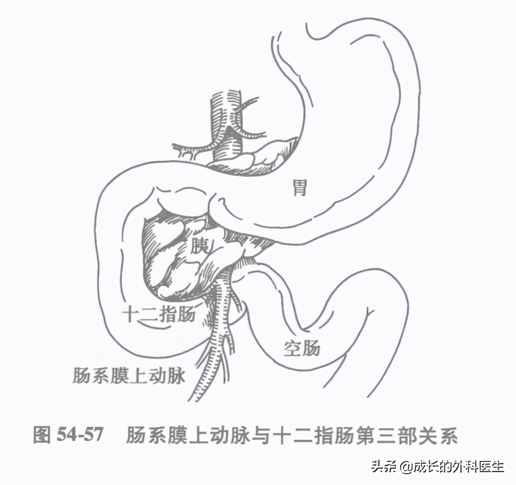 肠系膜上动脉压迫综合征ct表现,儿童肠系膜压迫综合征哪种手术好