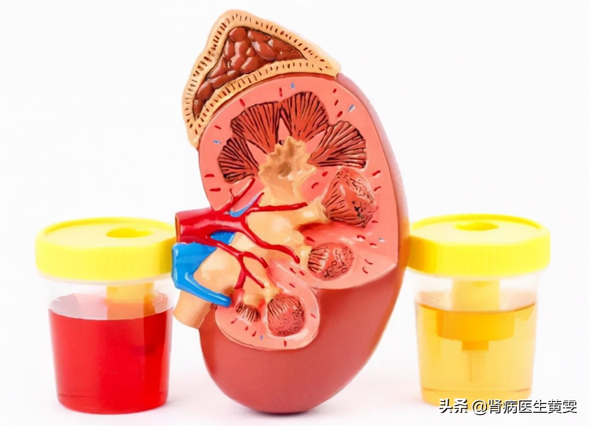 女性得IGA肾炎最初征兆,31岁女性得了IgA肾病怎样治疗