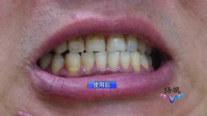 火遍网络的“牙齿美白神器”神奇吗?广电独家实验为你揭秘