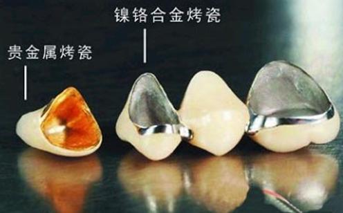 烤瓷牙崩瓷修复的详细步骤,烤瓷牙崩瓷必须更换吗