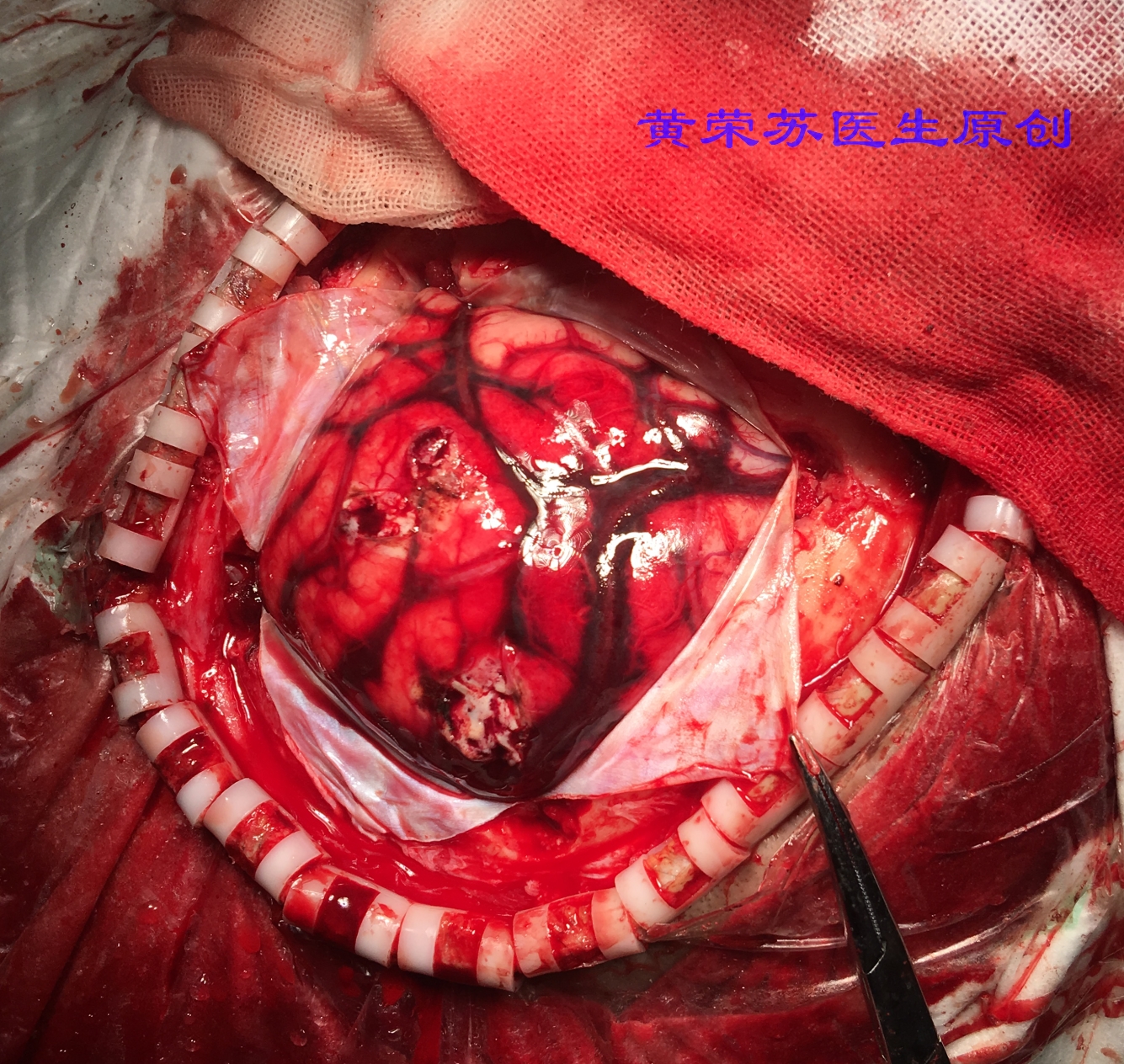 脑出血症状科普动画视频,脑出血的出血部位脑细胞会坏死吗