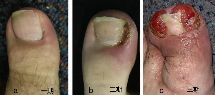脚食指甲沟炎修甲过程,掌健识健康百科