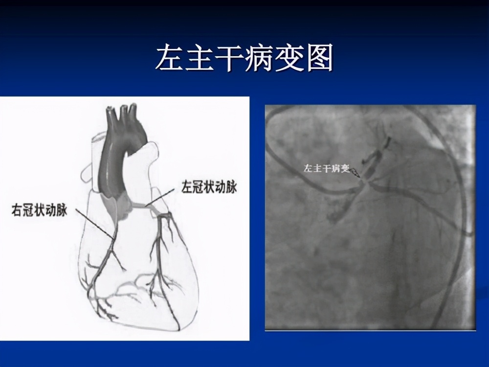 心脏刚下过支架病人应注意什么,刚做完心脏支架还有症状怎么回事