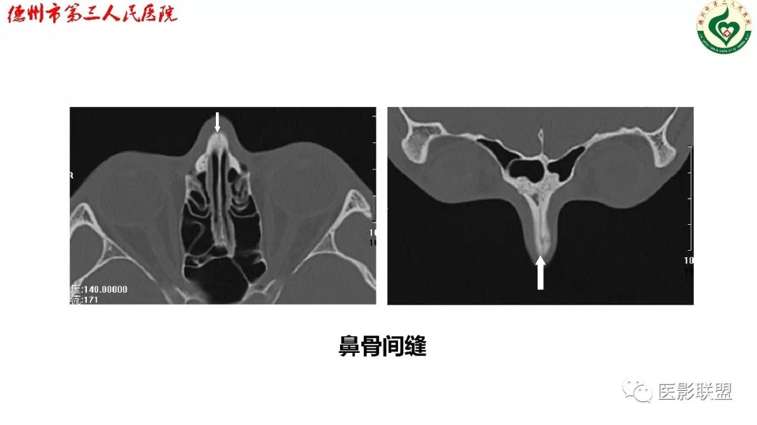 鼻骨骨折影像,鼻骨骨折dr影像表现