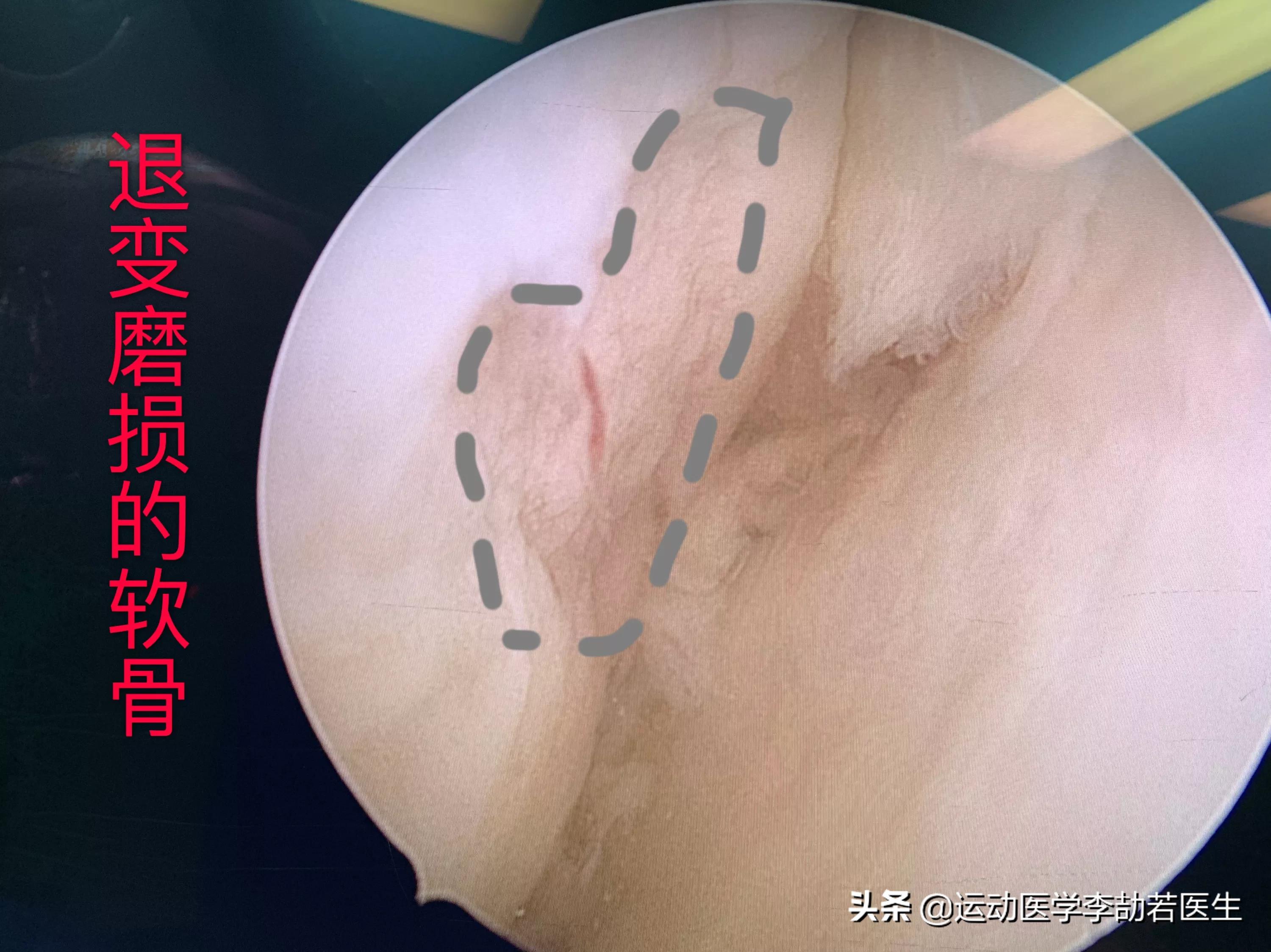 骨关节炎如何彻底治好,骨关节炎怎么治疗最好最有效