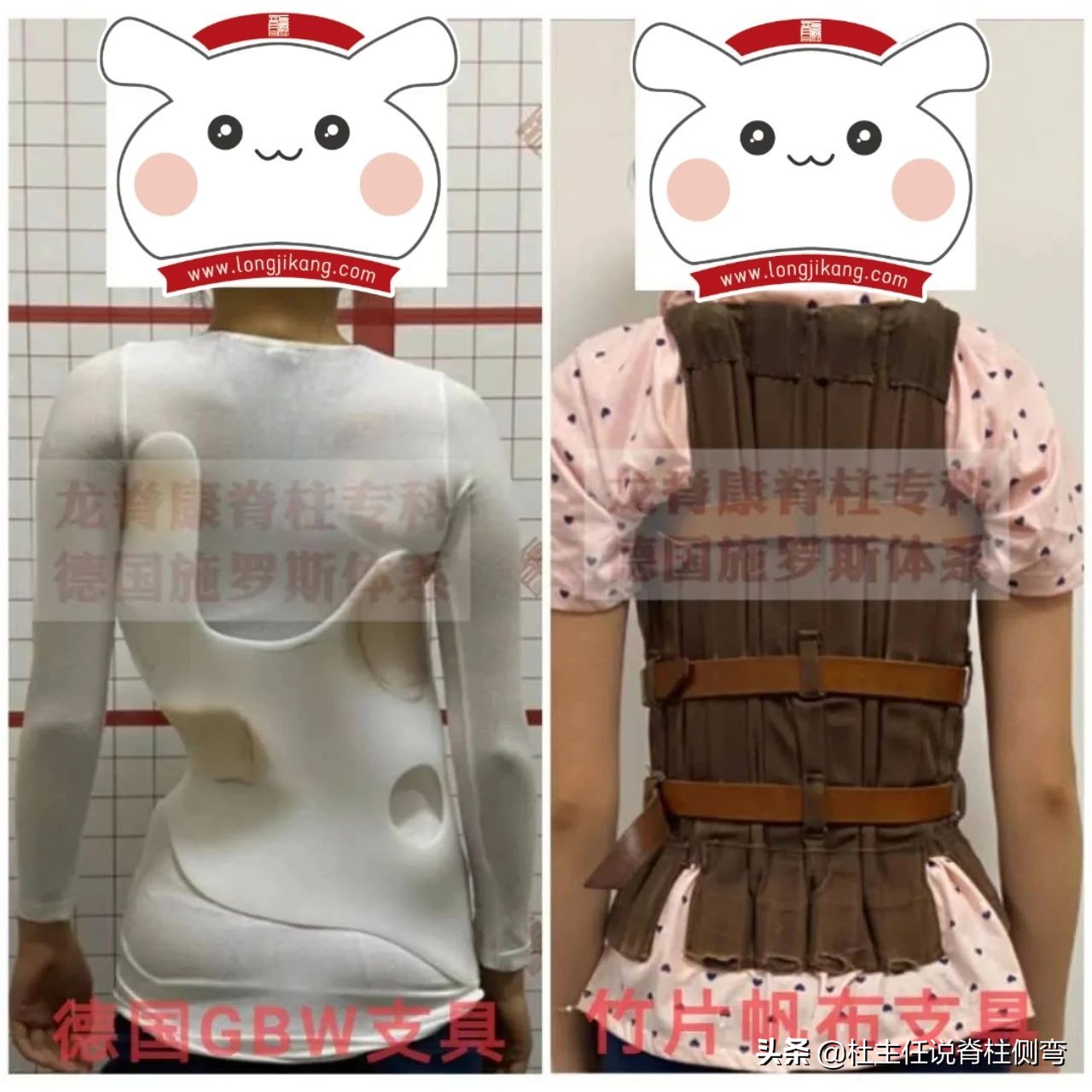 女孩17岁脊柱侧弯有加重现象,12岁女孩脊柱侧弯戴支具能恢复吗