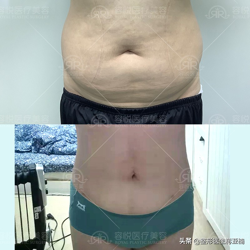 苹果肌吸脂抽出来的是血水,下额吸脂吸出来的都是血水