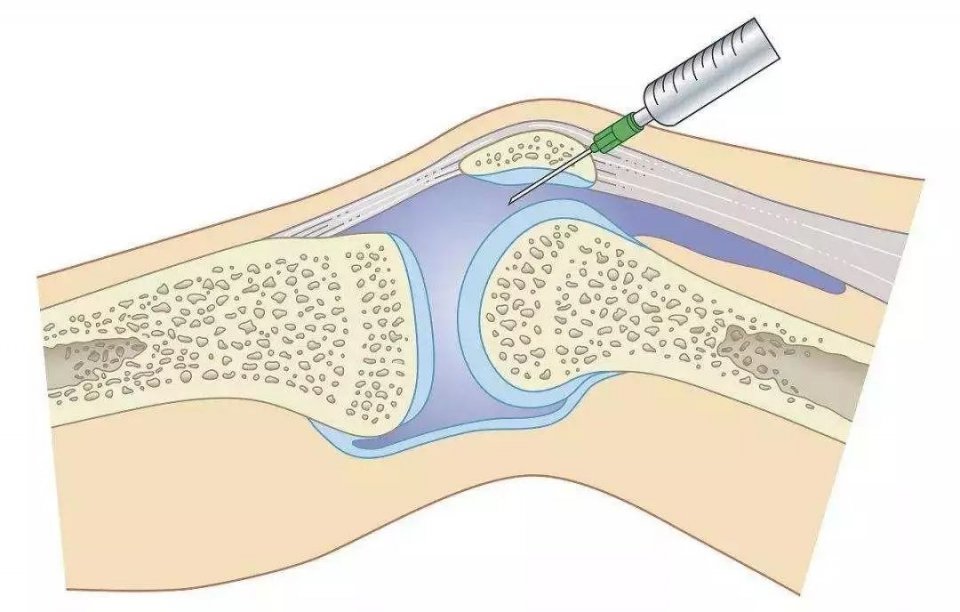 膝关节炎问诊,骨科医生谈膝关节