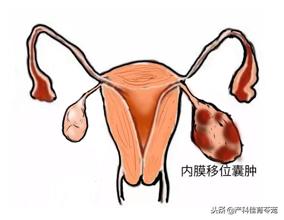 卵巢囊肿术后还有囊肿,卵巢囊肿是肿瘤性囊肿怎么治疗