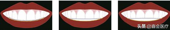怎么不露齿笑才自然好看,如何笑不露齿笑起来好看的技巧