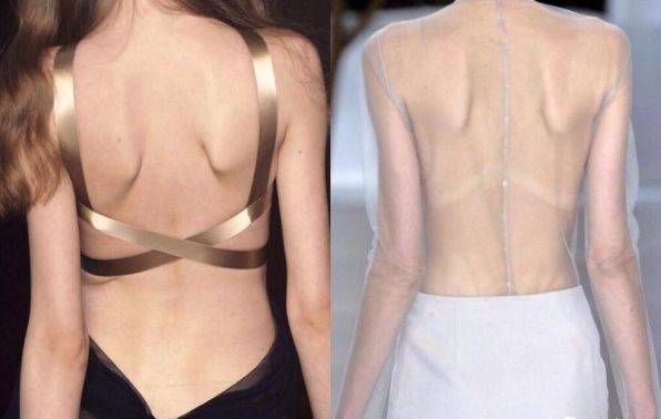 改善含胸驼背弹力带有用吗,弹力带含胸驼背改善训练