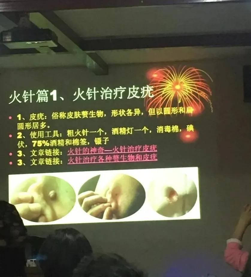 北京艾灸经络推拿培训,艾灸培训有感